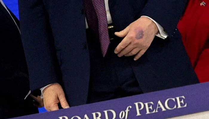 Trump’s hands seen bruised in new photos